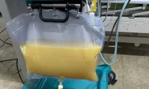 Huyết tương trắng đục như sữa do nghiện rượu