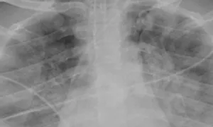 Người phụ nữ nguy kịch bởi nhiễm 'khuẩn ăn thịt người'